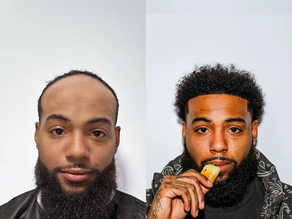 Dakonta H. before and after hair transplant result