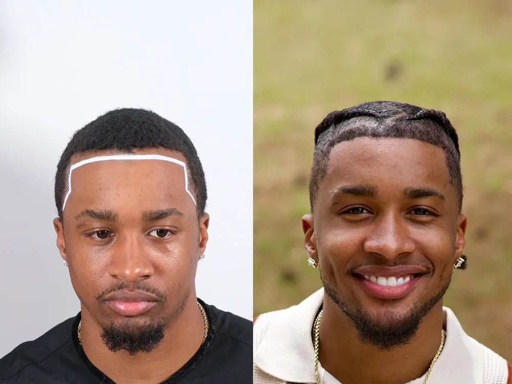 Tarik G. before and after hair transplant result