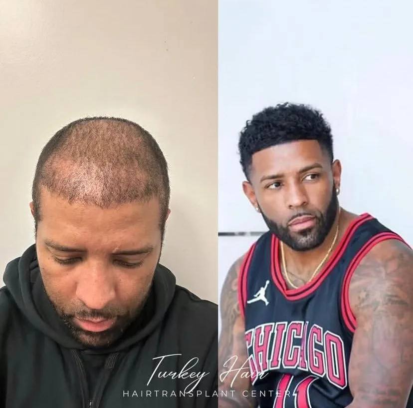 Hair transplant before and after result — Turkey Hair Center patient