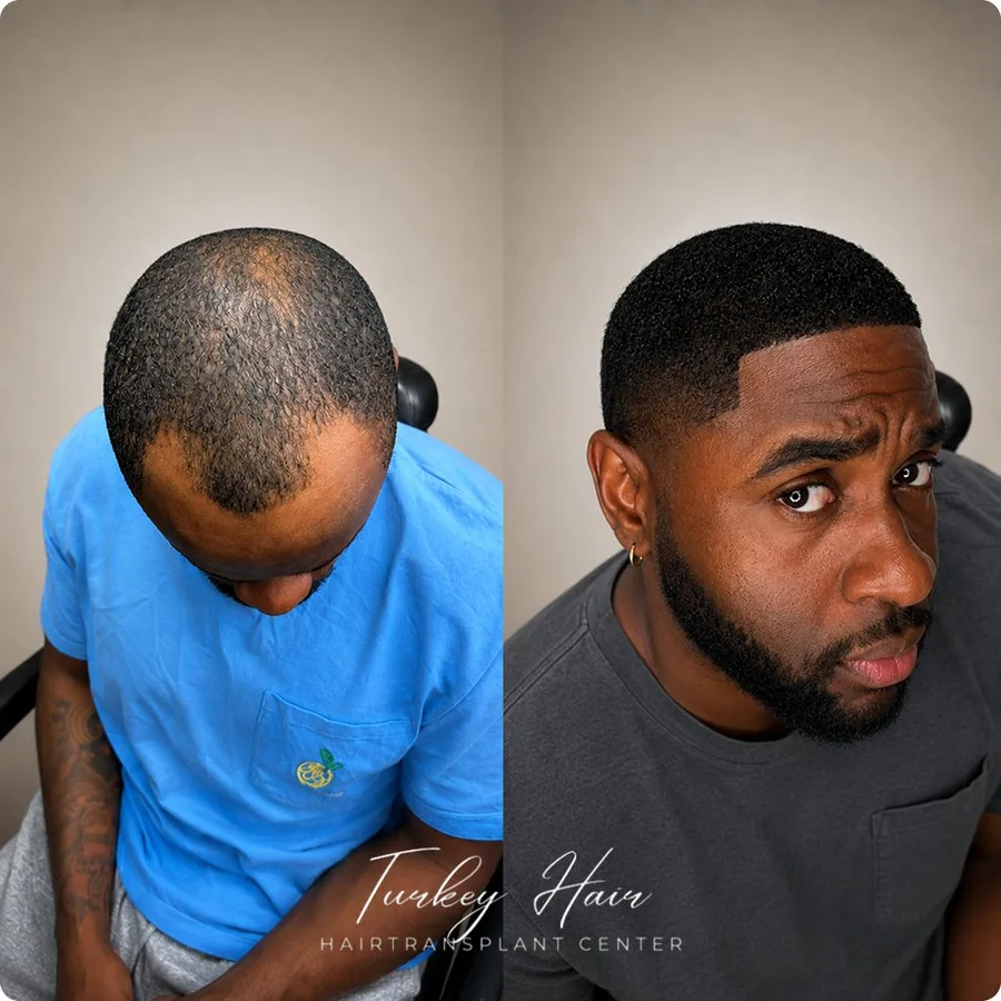 Hair transplant before and after result — Turkey Hair Center patient