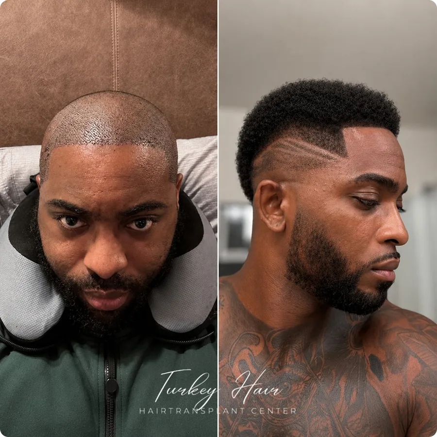 Hair transplant before and after result — Turkey Hair Center patient