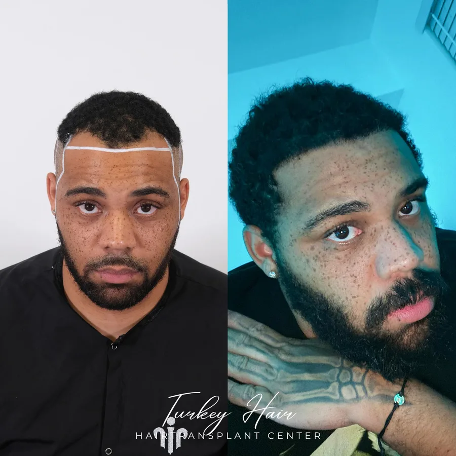 Hair transplant before and after result — Turkey Hair Center patient