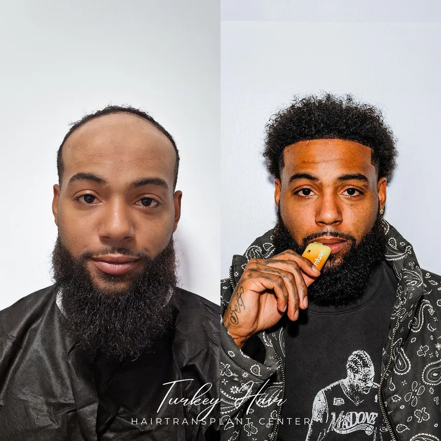 Hair transplant before and after result — Turkey Hair Center patient