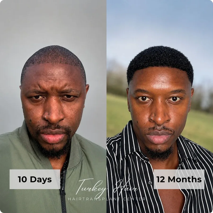 Hair transplant before and after result — Turkey Hair Center patient