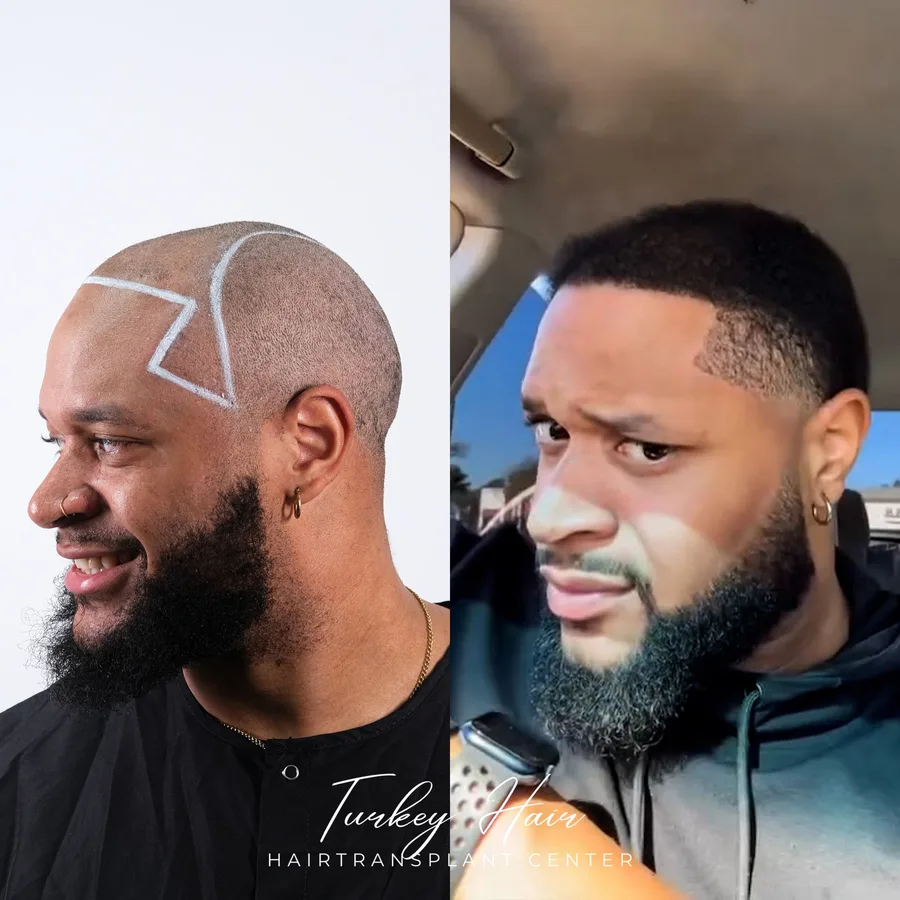 Hair transplant before and after result — Turkey Hair Center patient