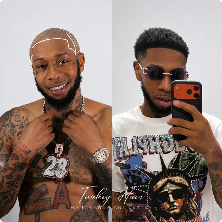 Hair transplant before and after result — Turkey Hair Center patient