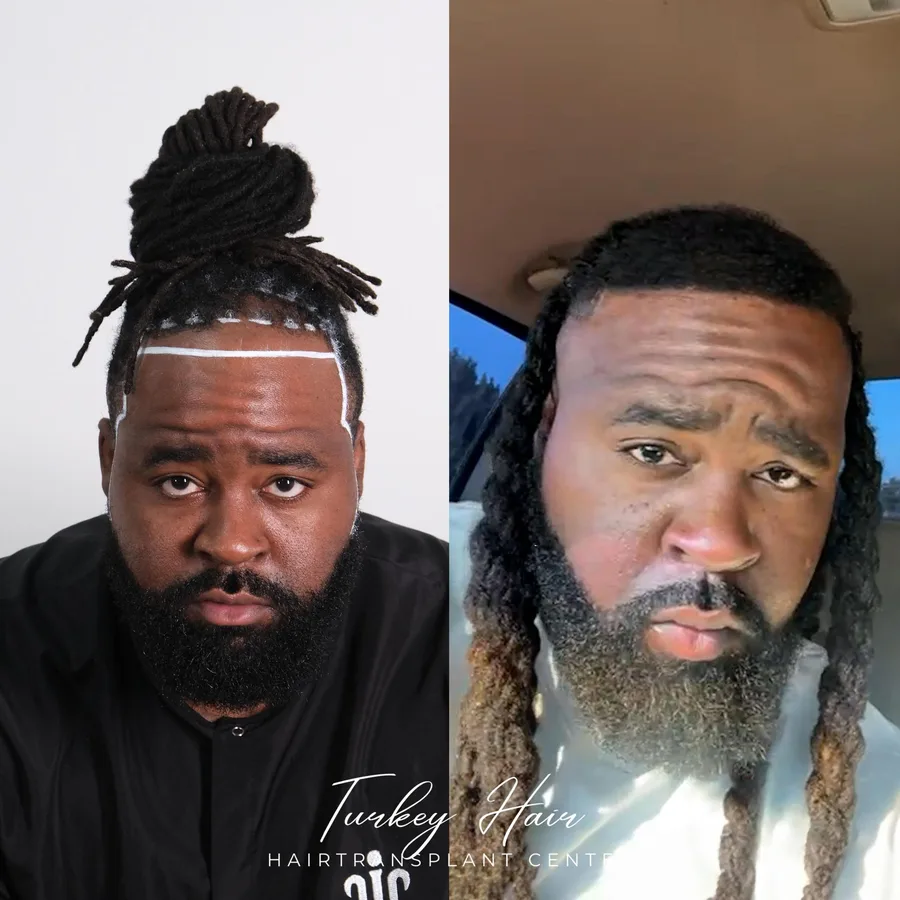 Hair transplant before and after result — Turkey Hair Center patient