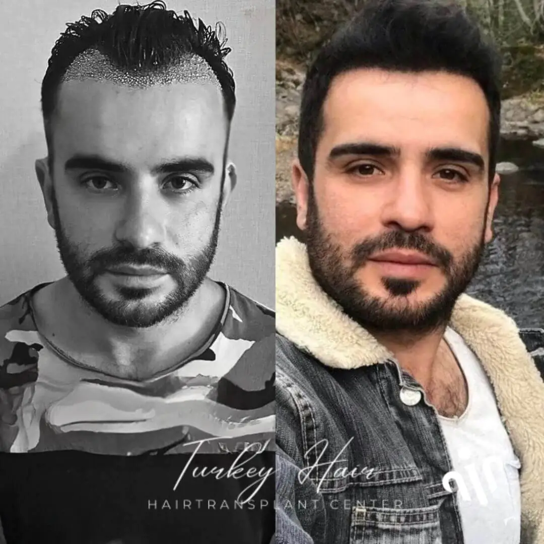 1000-grafts-hair-transplant-before-after-2.jpg