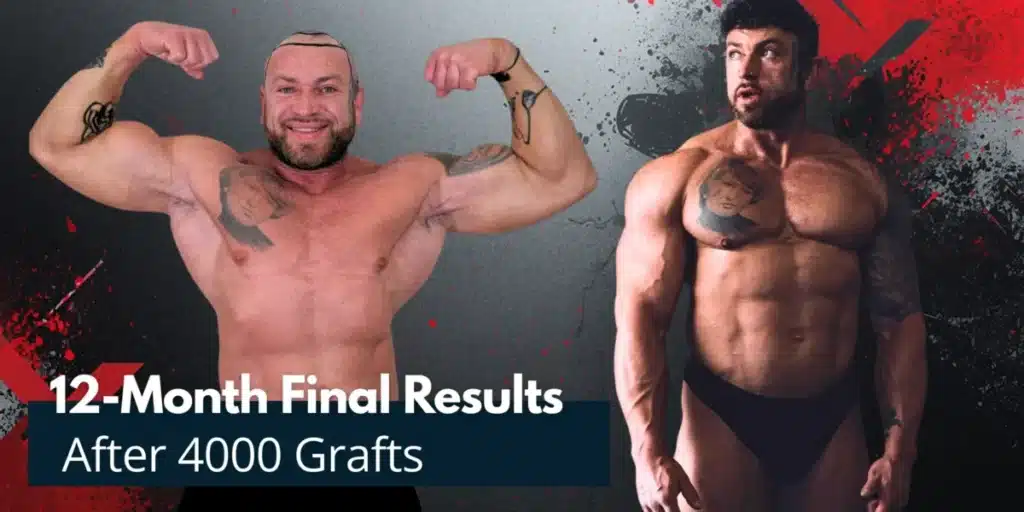 12-Month-Final-Results-After-4000-Grafts-1200x600