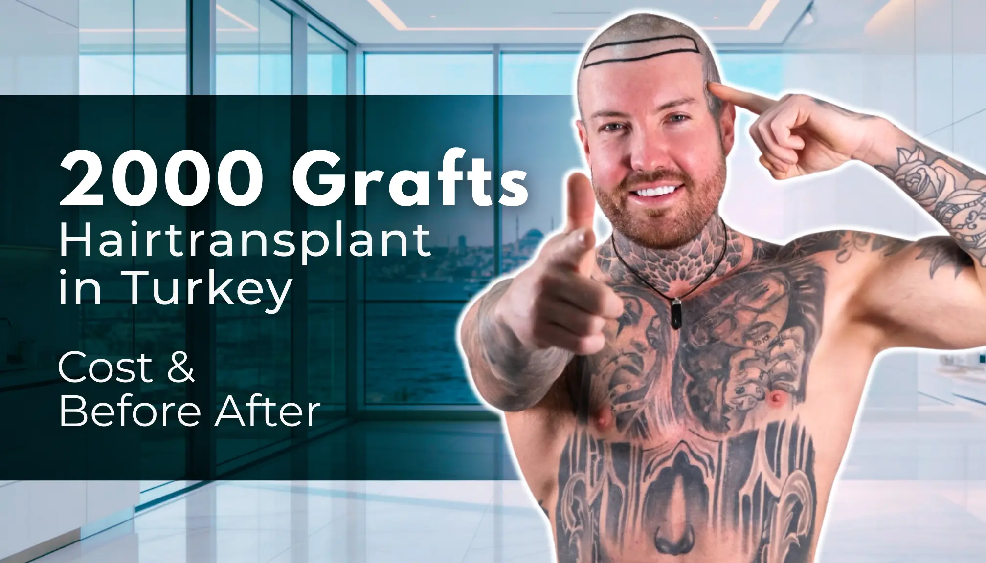 2000 Grafts Hair Transplant in Turkey – Cost & Before After