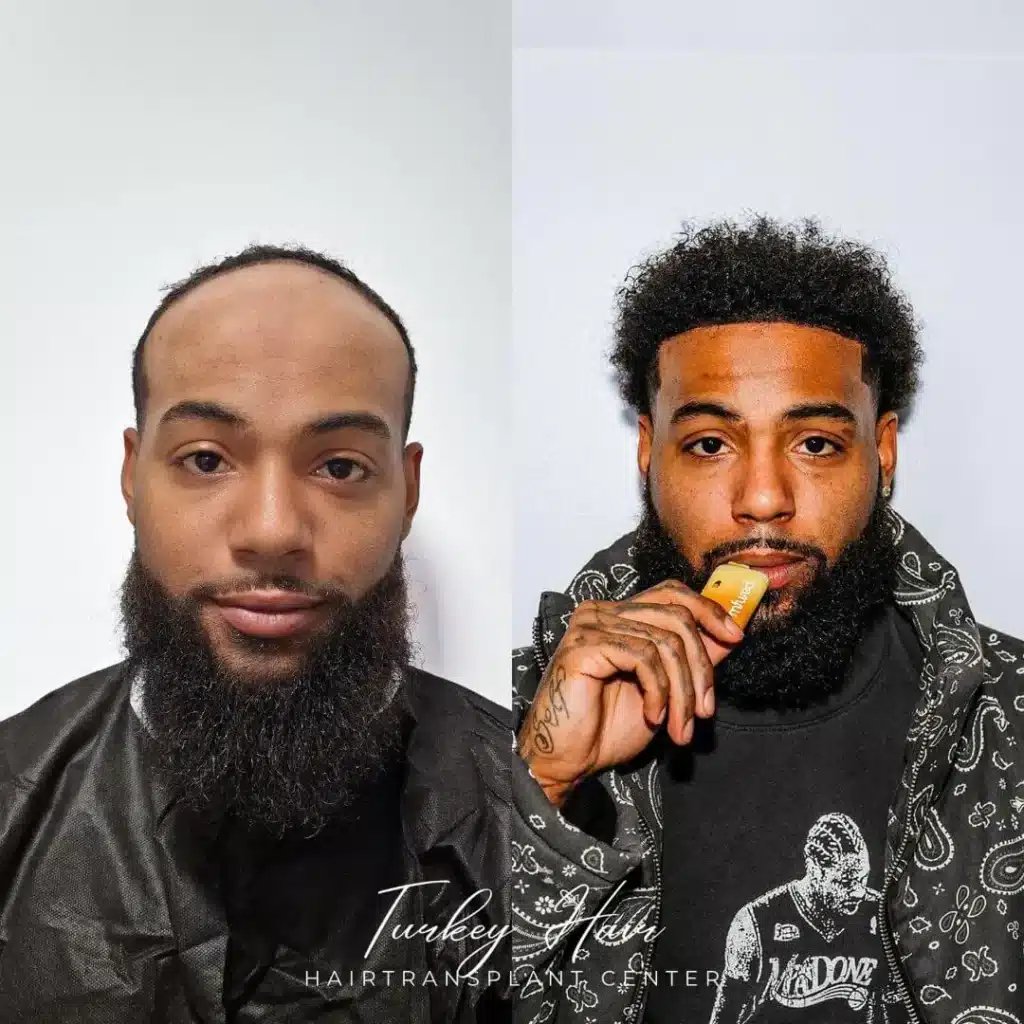 5000-grafts-hair-transplant-before-after-1.jpg