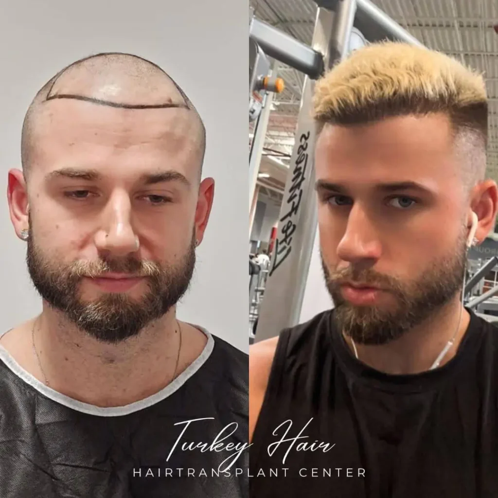 5000-grafts-hair-transplant-before-after-2.jpg