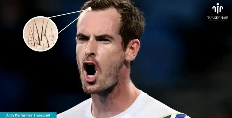ANDY-MURRAY-HAIR-TRANSPLANT-2-2-1-768x390