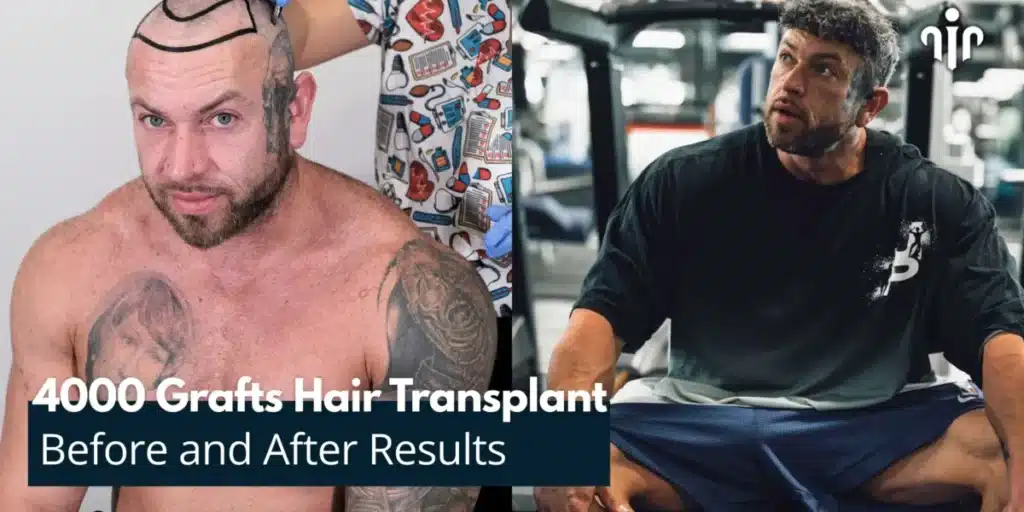 Before-and-After-Results-of-4000-Grafts-Hair-Transplant-1200x600