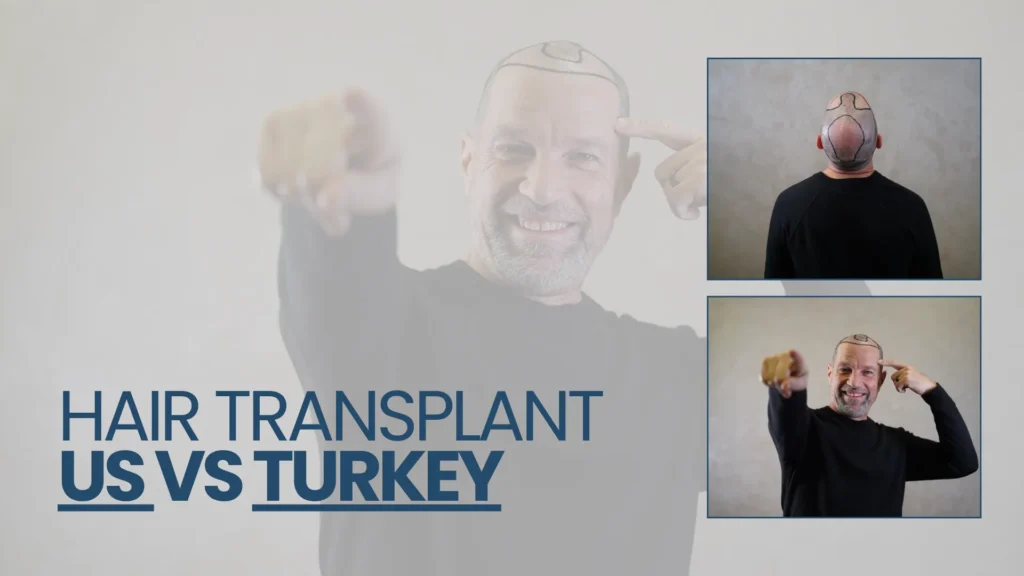 Determine-Hair-Transplant