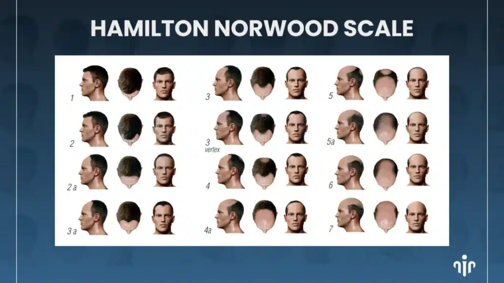 Hairstyles-for-Advanced-Hair-Loss-1280x720