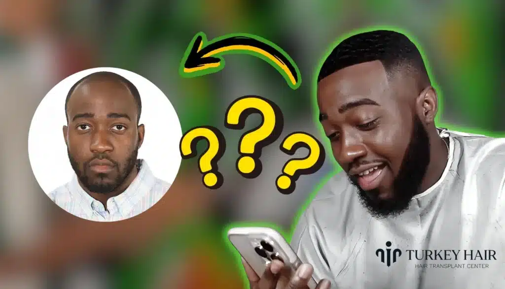 Jidion-Hair-Transplant-Before-After-1024x587