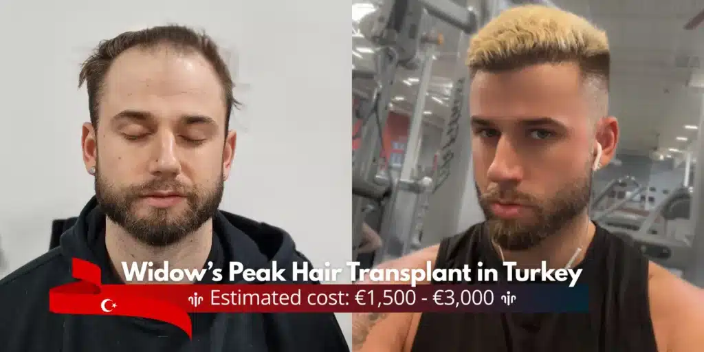 Widows-Peak-Hair-Transplant-Cost-in-Turkey