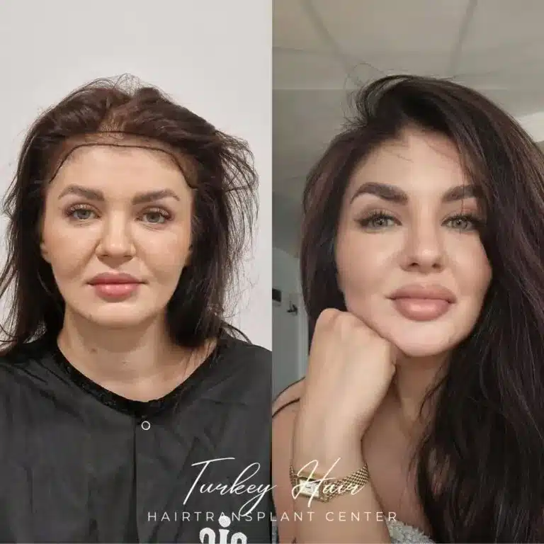 Women-1000-grafts-hair-transplant-before-after-768x768.jpg