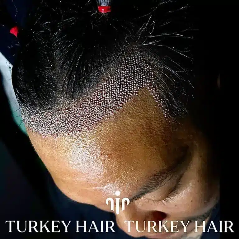 after-1000-grafts-hair-transplant-768x768.jpg