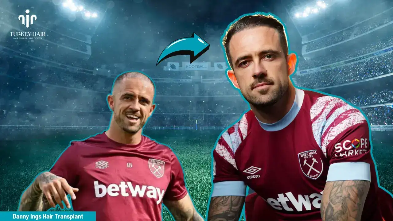 Let’s Discover Successfull Striker Danny Ings’ Hair Transplant 2026