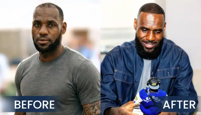 lebron-james-hair-transplant-before-after-comparison-768x439 lebron james hair transplant before after
