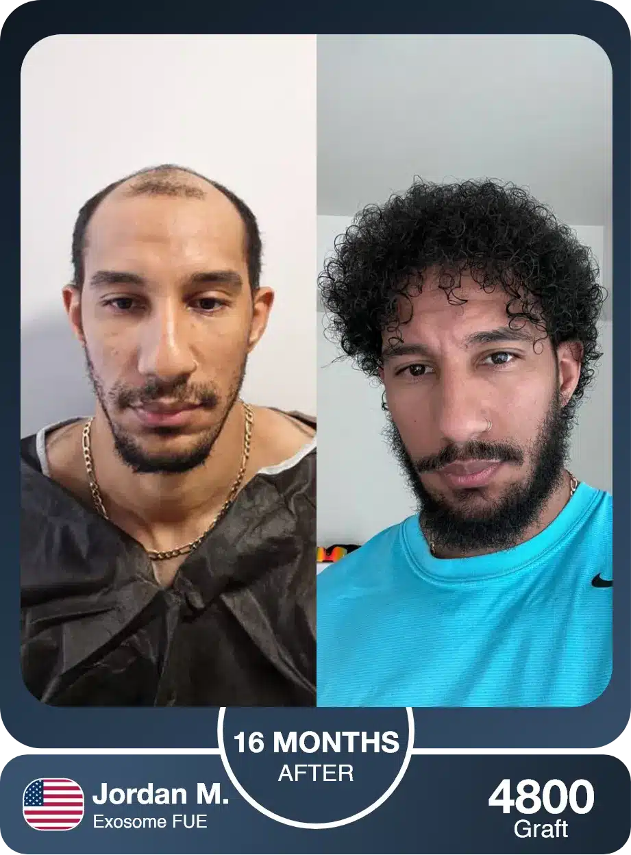 Exsome Afro Hair Transplant Before And After Result