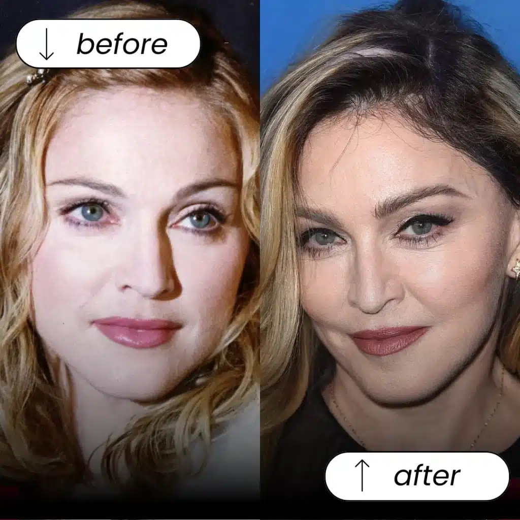 Eyebrow Transplant In Turkey – Cost, Before & After 11 Eyebrow Transplant In Turkey – Cost, Before & After Hair Restoration Excellence You Can Trust