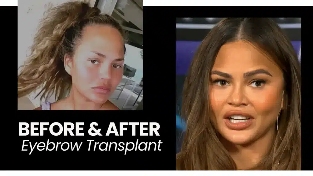 Eyebrow Transplant In Turkey – Cost, Before & After 10 Eyebrow Transplant Before And After