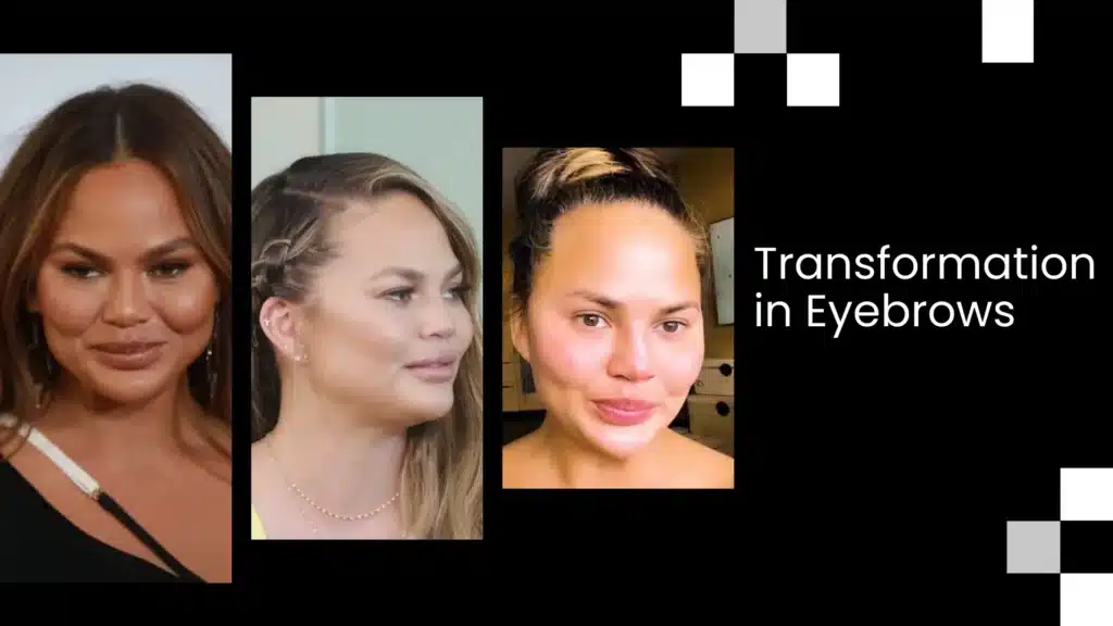 Eyebrow Transplant In Turkey – Cost, Before & After 9 Eyebrow Transplant Transformation Before And After