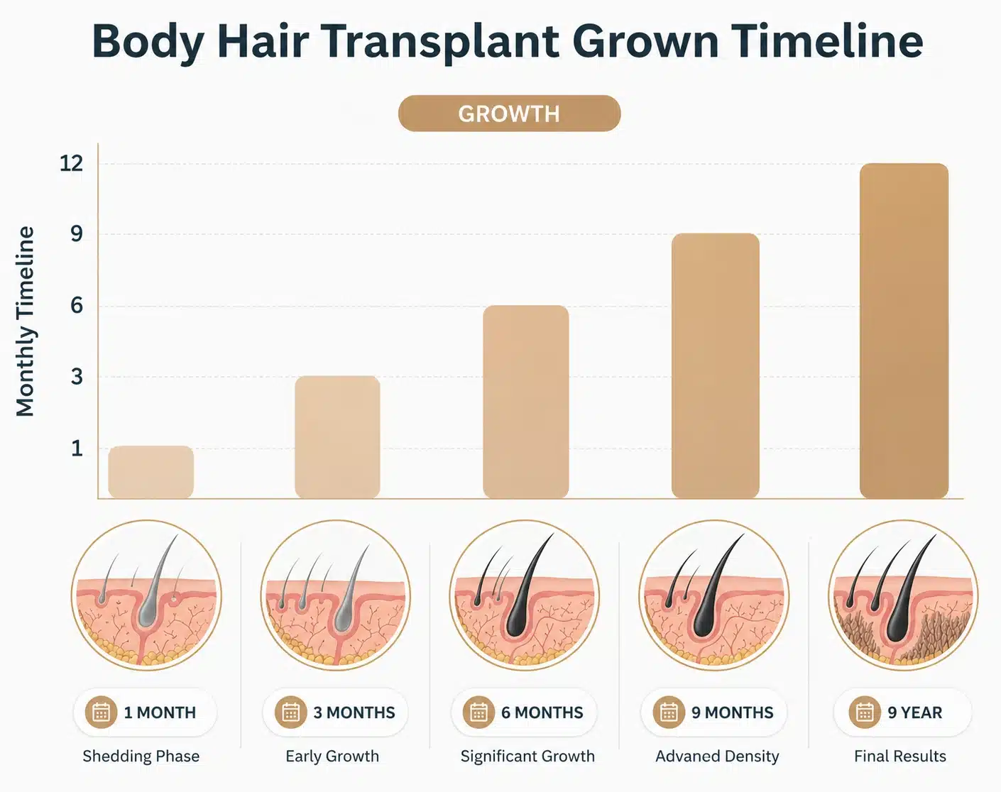 Body Hair Transplant In Turkey: Cost, Procedure & Before-After 10 Body Hair Transplant In Turkey: Cost, Procedure & Before-After Hair Restoration Excellence You Can Trust