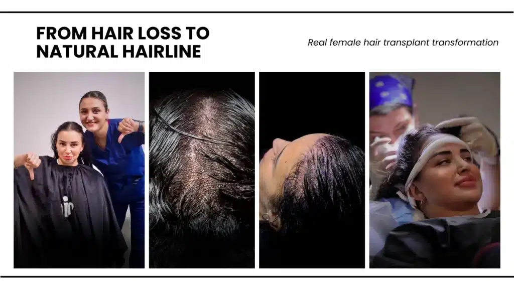 Hair Transplant For Women 10 Common Hair Loss Issues In Female