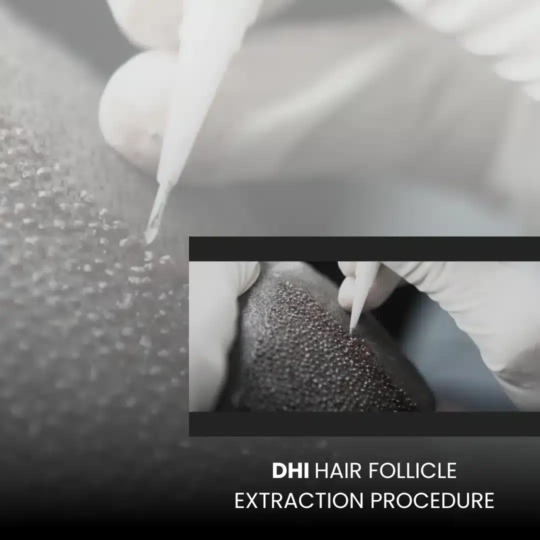 Dhi Hair Transplant 13 Dhi Hair Transplant Procedure