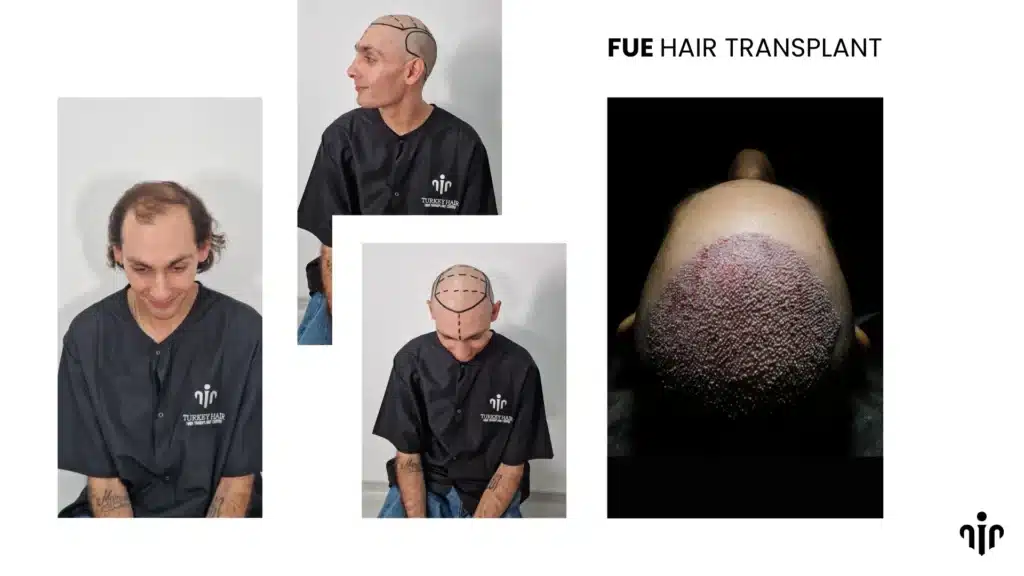 Fue Hair Transplant In Turkey – Cost, Before & After 15 Fue Hair Transplant Is A Modern Technique Where Individual Hair Follicles Are Extracted And Implanted For Natural-Looking Results.