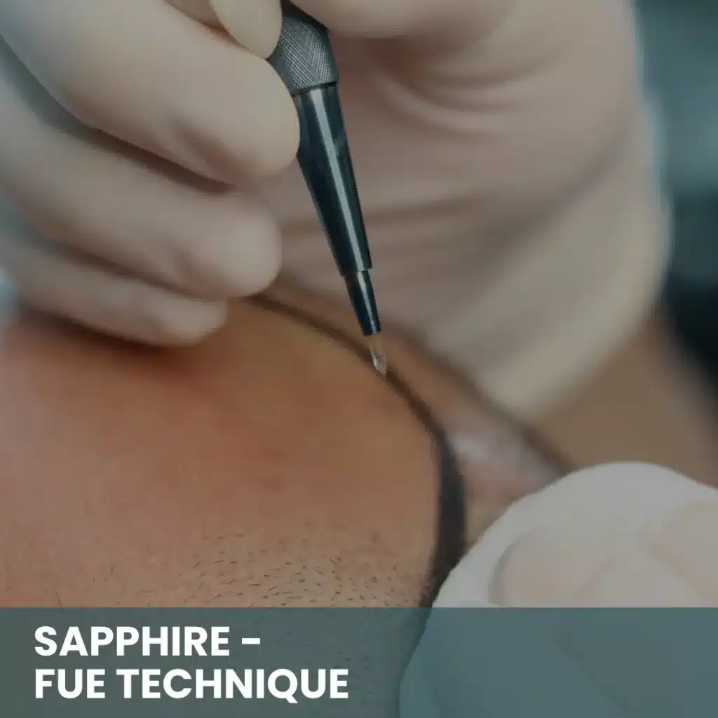 Fue Hair Transplant In Turkey – Cost, Before & After 11 Sapphire Fue Hair Transplant Procedure
