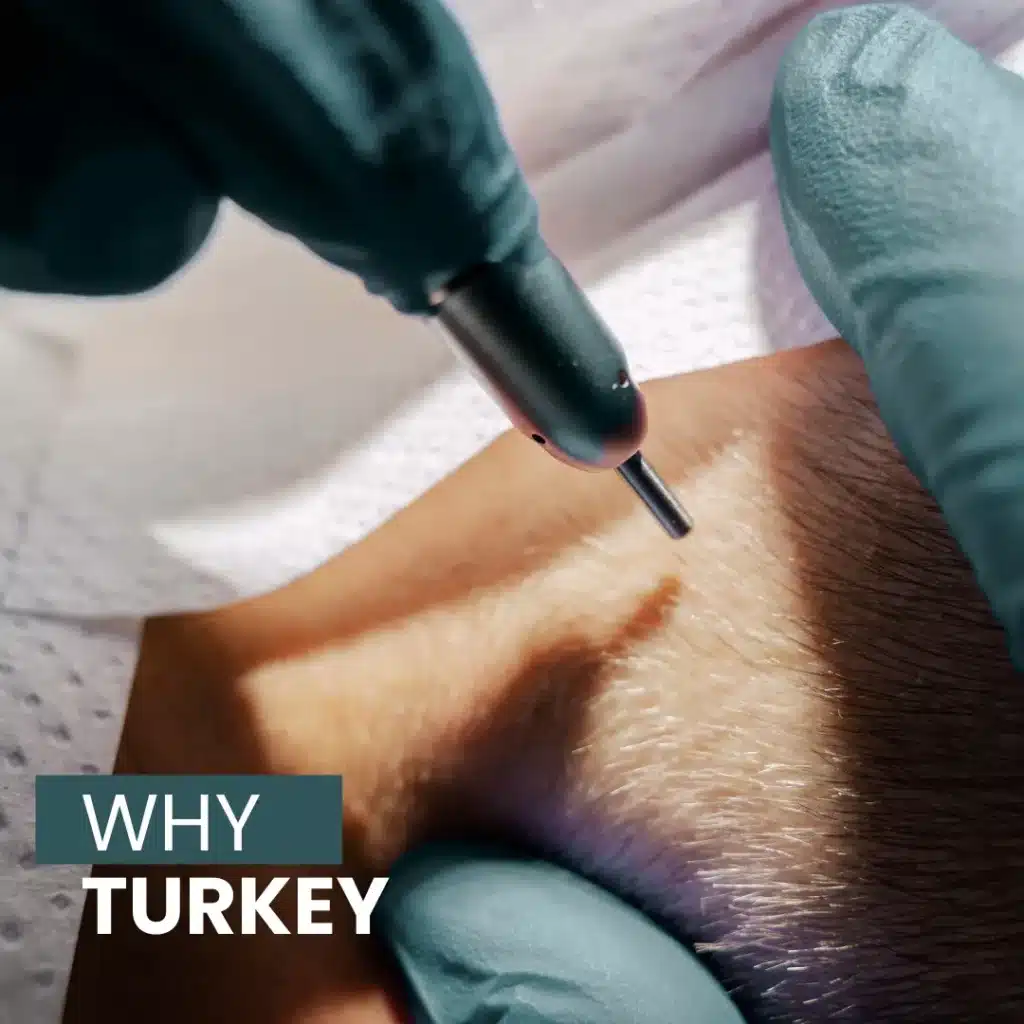 Fue Hair Transplant In Turkey – Cost, Before & After 8 Discover Why Turkey Is A Top Destination For Hair Transplant Procedures.