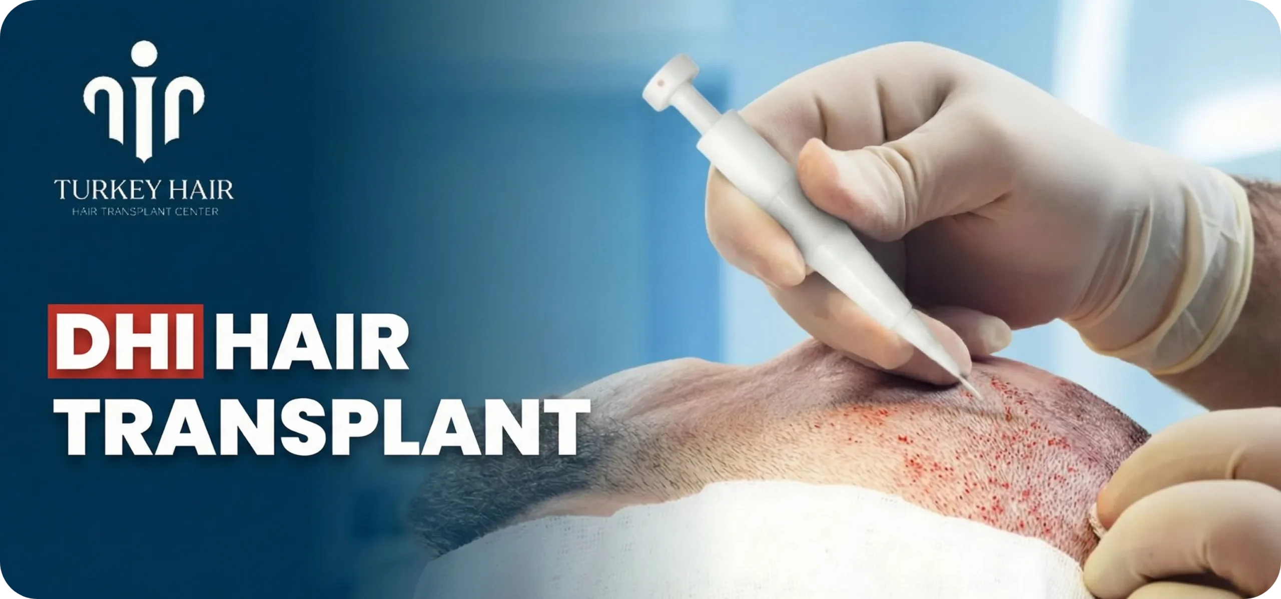 Dhi Hair Transplant In Turkey – Cost, Before & After Hair Restoration Excellence You Can Trust