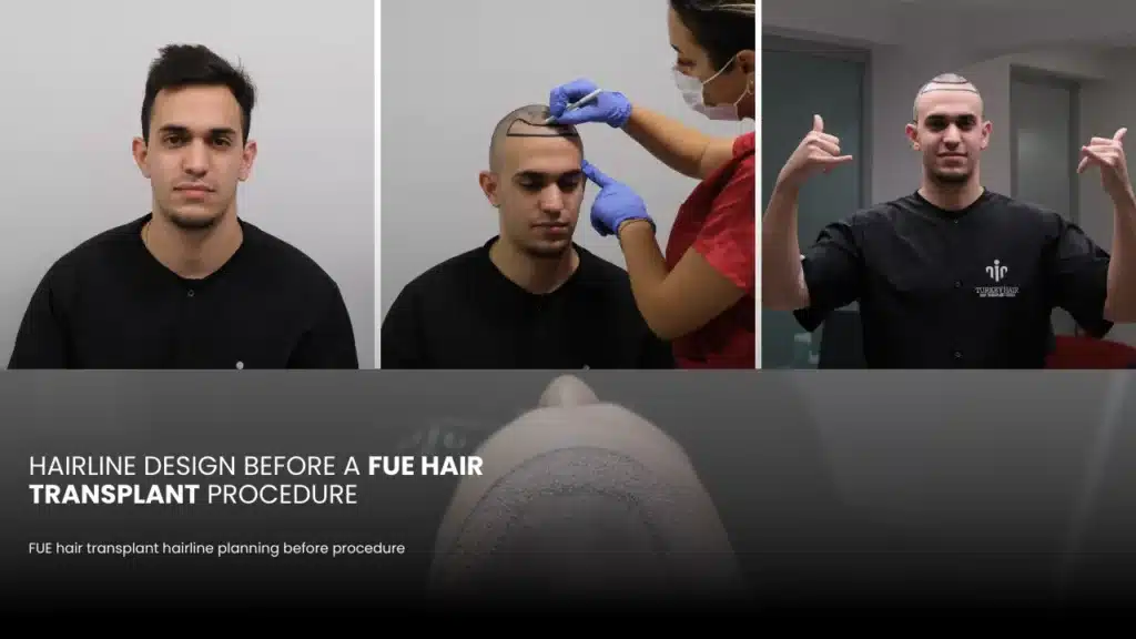 Fue Hair Transplant In Turkey – Cost, Before & After 13 Hairline Design Is The Key To Achieving Natural And Aesthetically Balanced Hair Transplant Results.