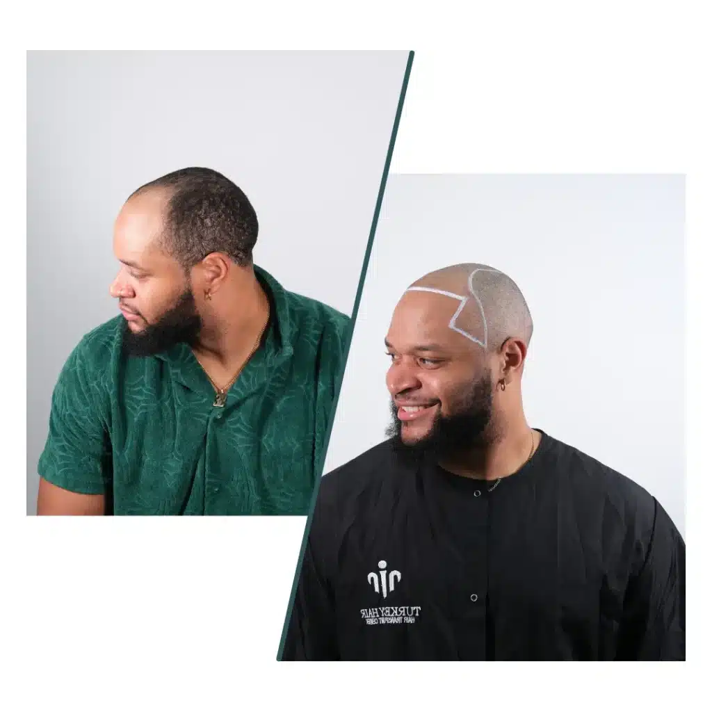Fue Hair Transplant In Turkey – Cost, Before & After 14 Before Hair Transplant Showing Planned Hairline Design Drawn On The Scalp