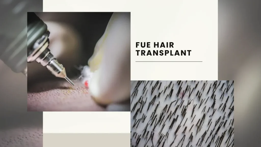 Fue Hair Transplant In Turkey – Cost, Before & After 10 Fue Hair Transplant Technique Involves Precise Extraction Of Individual Follicles For Natural-Looking Hair Restoration.
