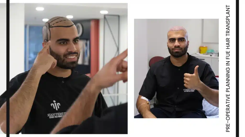Fue Hair Transplant In Turkey – Cost, Before & After 16 Operation Planning Is A Crucial Step Where The Procedure Is Carefully Designed Based On The Patient’s Needs, Hair Structure, And Desired Results.