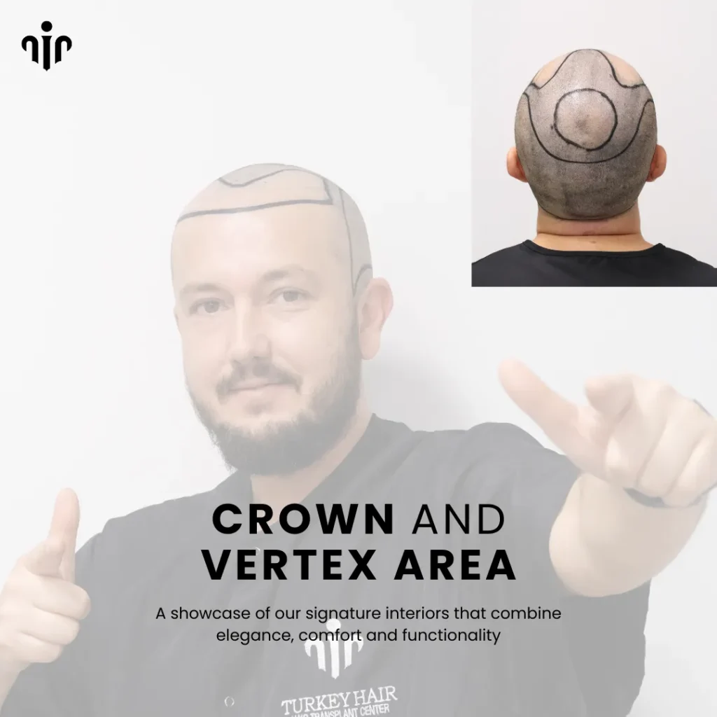 Fue Hair Transplant In Turkey – Cost, Before & After 12 Hair Transplant In The Vertex And Crown Areas Requires Careful Planning For Natural Density And Growth Direction.