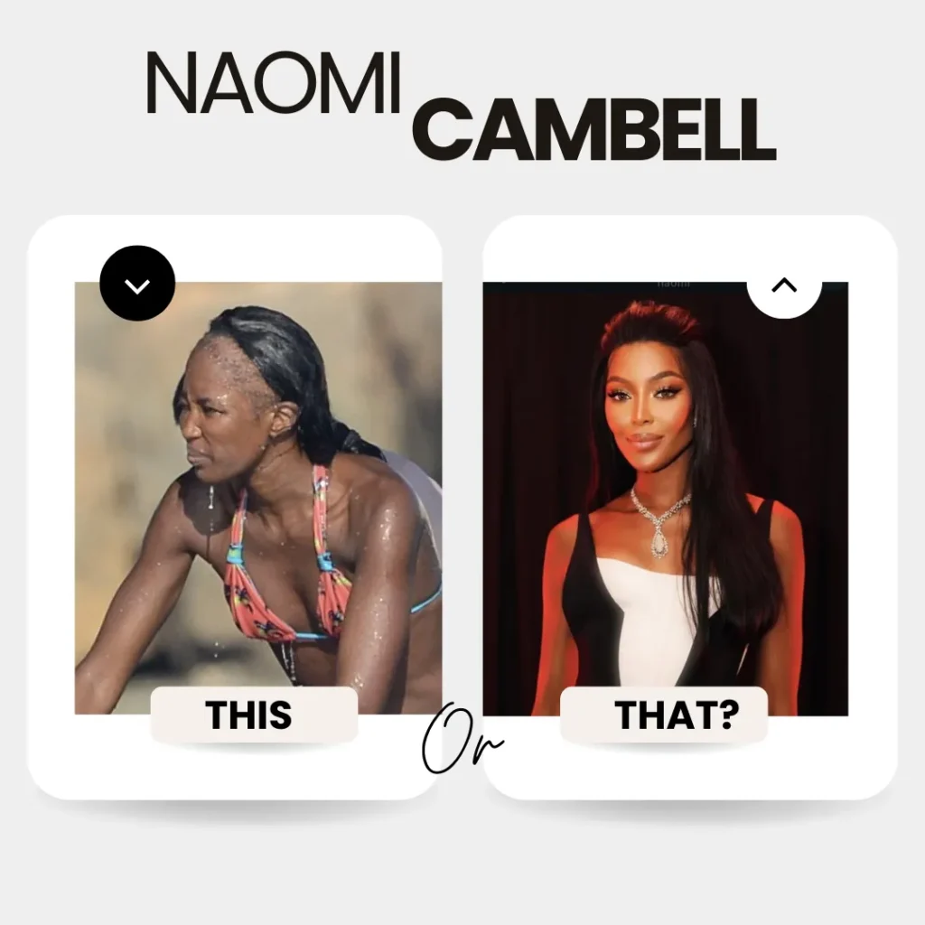 Hair Transplant For Women 13 Naomi Campbell Before And After The Hair Transplant