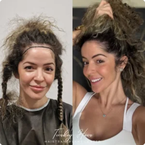 Before & After Hair Restoration Excellence You Can Trust