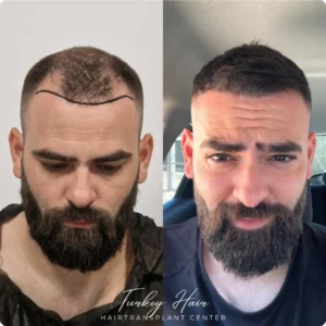 Before & After Hair Restoration Excellence You Can Trust