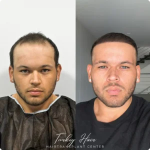Before & After Hair Restoration Excellence You Can Trust