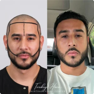 Before & After Hair Restoration Excellence You Can Trust