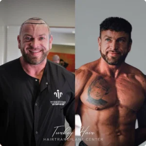Before & After Hair Restoration Excellence You Can Trust