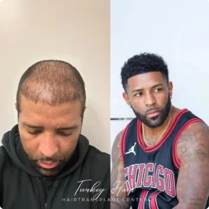 Before & After Hair Restoration Excellence You Can Trust