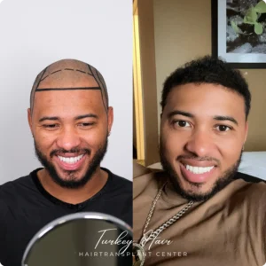 Before & After Hair Restoration Excellence You Can Trust